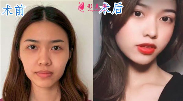 廈門安黛美醫(yī)療整形美容自體脂肪面填案例