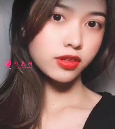 廈門安黛美醫(yī)療整形美容自體脂肪面填案例