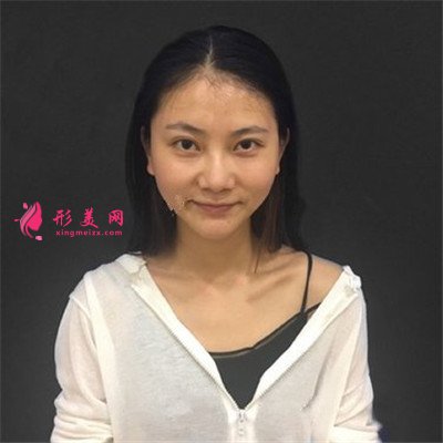 深圳耳軟骨隆鼻術后恢復情況對比