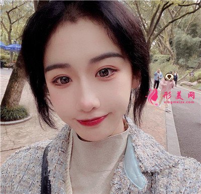 重慶埋線雙眼皮術(shù)后恢復(fù)效果對比