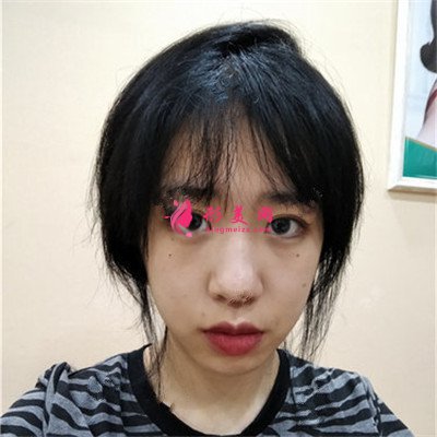 重慶埋線雙眼皮術(shù)后恢復(fù)效果對比