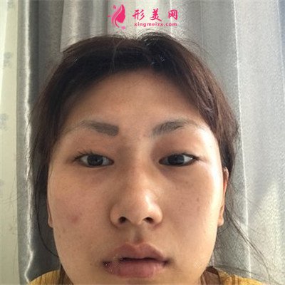 武漢全切雙眼皮術(shù)后恢復(fù)效果展示