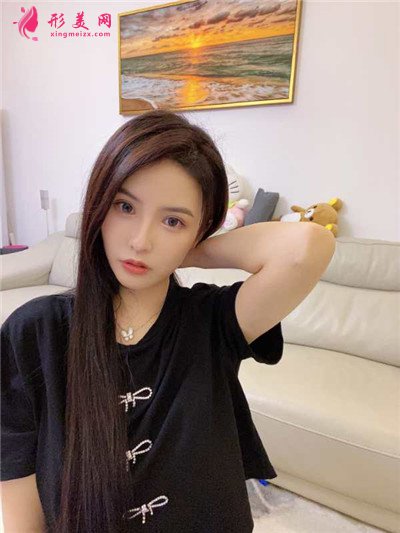 深圳定點(diǎn)雙眼皮術(shù)后恢復(fù)效果分享