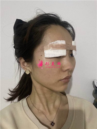 昆明眼部多項手術術后效果對比