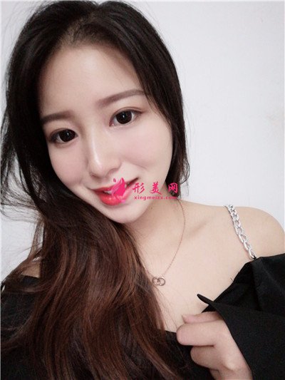 廈門全切雙眼皮手術(shù)術(shù)后效果對比