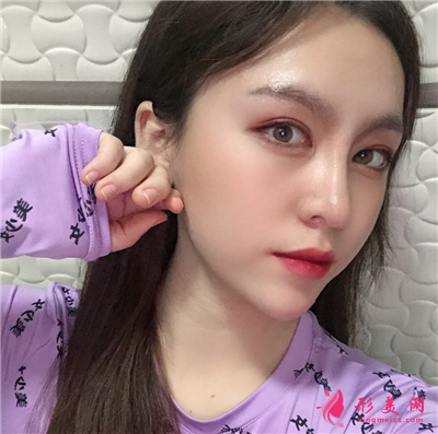 成都鼻綜合手術(shù)術(shù)后恢復(fù)效果對比 術(shù)后 成都鼻綜合手術(shù)術(shù)后恢復(fù)效果對比