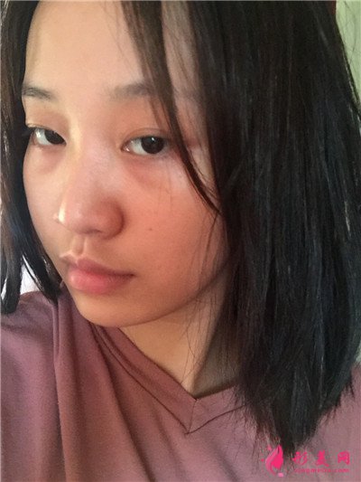 杭州面部埋線提升術(shù)后恢復(fù)情況分析