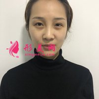 自體脂肪活細(xì)胞除皺真實(shí)體驗(yàn)分享