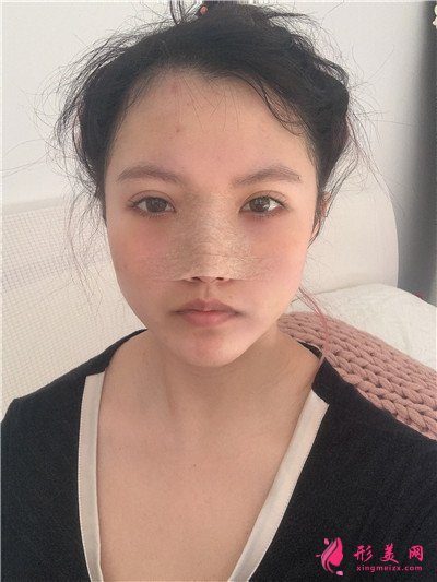 深圳耳軟骨隆鼻術(shù)后恢復(fù)情況對(duì)比案例分享