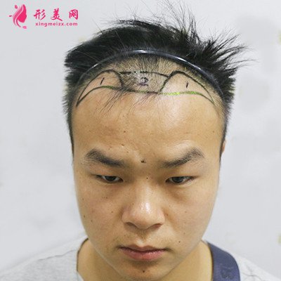 重慶毛發(fā)移植手術(shù)術(shù)后恢復(fù)情況分析