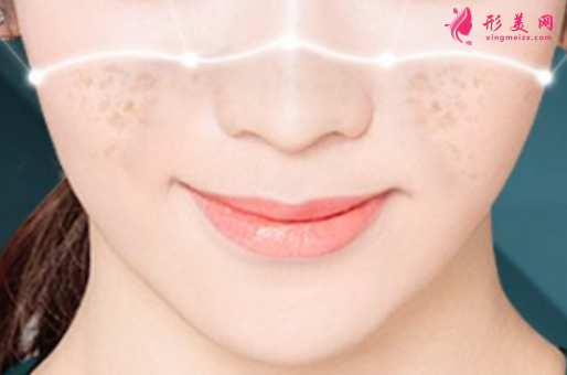 激光祛斑會(huì)痛么