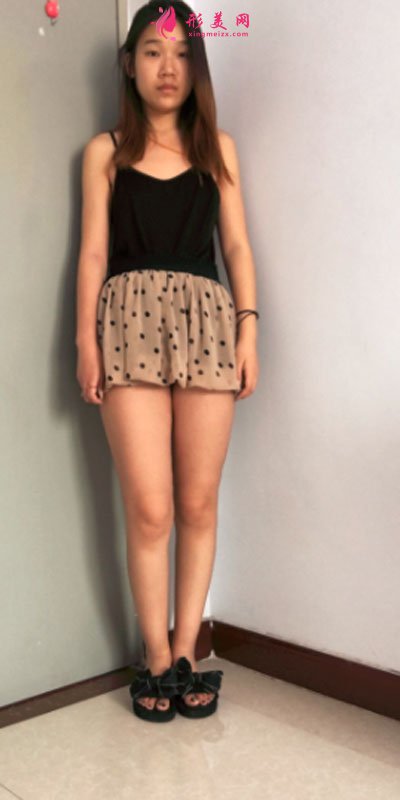 重慶美圣美邦醫(yī)療美容整形吸脂瘦大腿案例