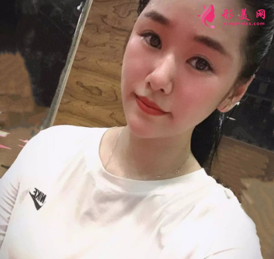 長虹醫(yī)療分享光子嫩膚真實(shí)案例 術(shù)后94天效果圖