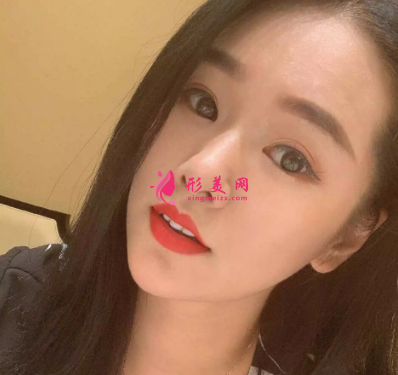 長虹醫(yī)療分享光子嫩膚真實(shí)案例 術(shù)后94天效果圖