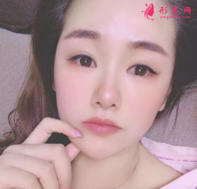 長虹醫(yī)療分享光子嫩膚真實(shí)案例 術(shù)后94天效果圖