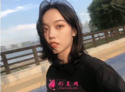 洛陽維美陳海濤做的雙眼皮 95天后效果真的很好