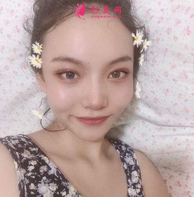 洛陽維美陳海濤做的雙眼皮 95天后效果真的很好