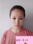 成都碧蓮盛植發(fā)種植發(fā)際線好不好？