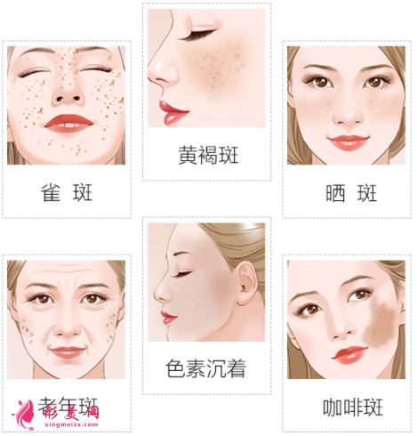 黃金超皮秒祛斑有哪些優(yōu)勢(shì)