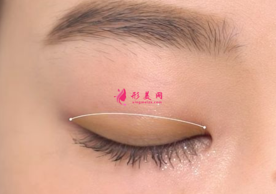 切開雙眼皮有疤痕要怎么辦