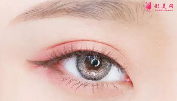 切開雙眼皮多久變得自然