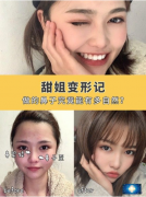 北京京民整形外科王志堅醫(yī)生隆鼻案例，歪鼻子再也沒有了