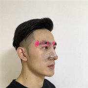 南京華美美容醫(yī)院小哥哥鼻部修復(fù)術(shù)后效果反饋