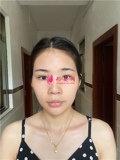 重慶吸脂瘦臉術后恢復情況對比