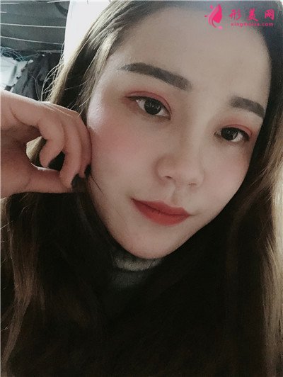 成都小仙女全切雙眼皮手術(shù)術(shù)后效果對比