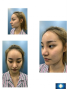 上海九院王濤做隆鼻修復(fù)已經(jīng)兩個月啦