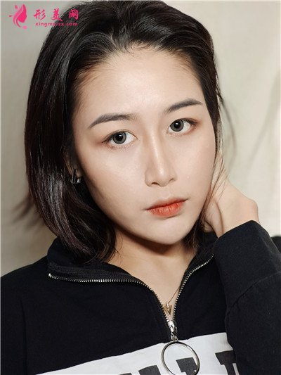 鄭州耳軟骨隆鼻術(shù)后恢復(fù)情況對比分享 術(shù)后 鄭州耳軟骨隆鼻術(shù)后恢復(fù)情況對比分享