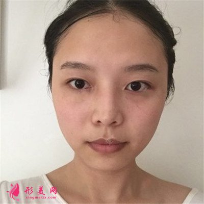 成都全切雙眼皮術后恢復情況對比分享