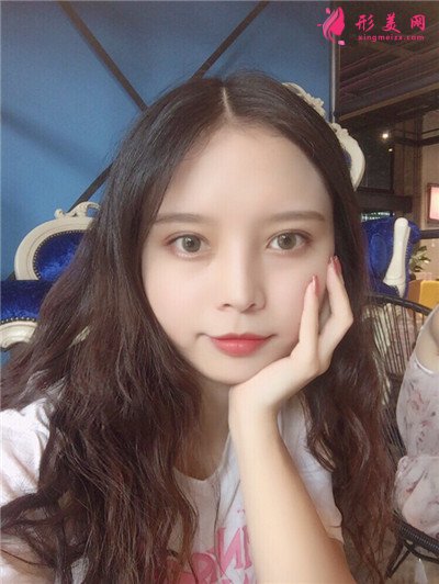 成都全切雙眼皮術后恢復情況對比分享