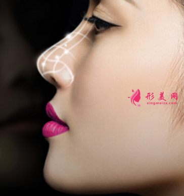 自體軟骨隆鼻適合哪些人群