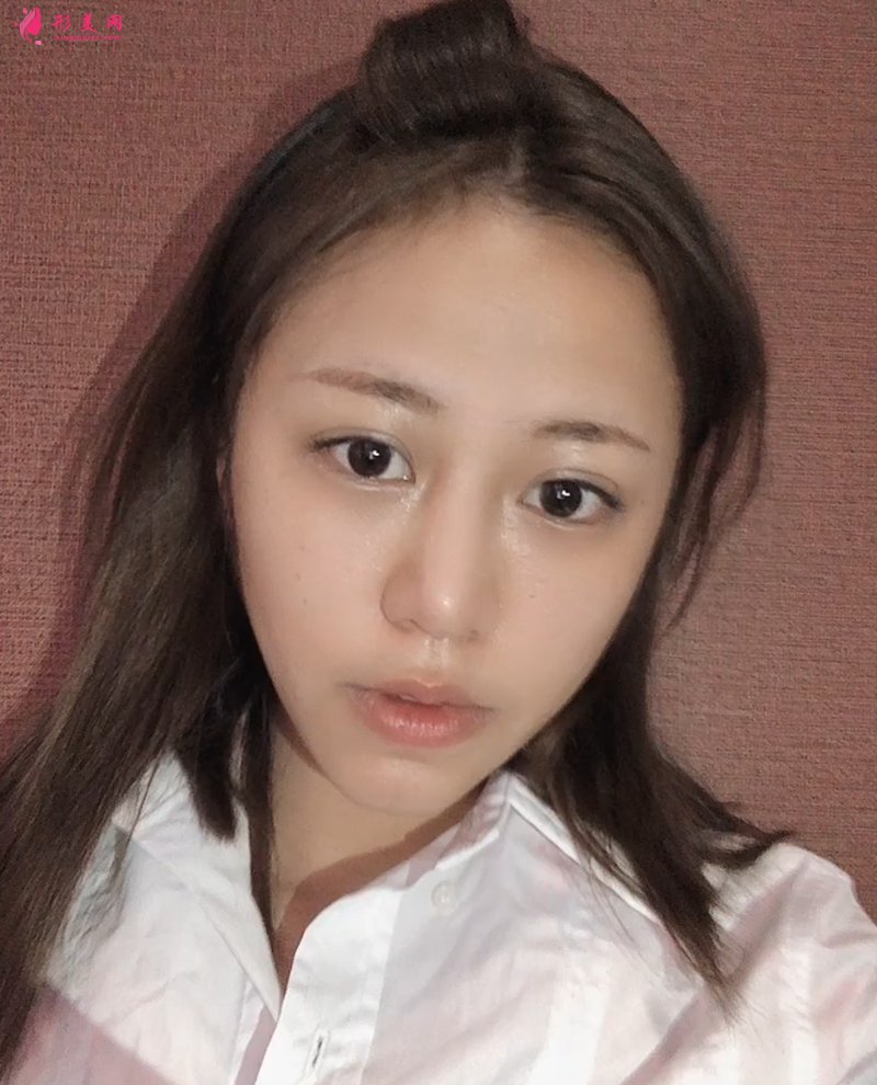 上海自體脂肪面部填充前后對比圖