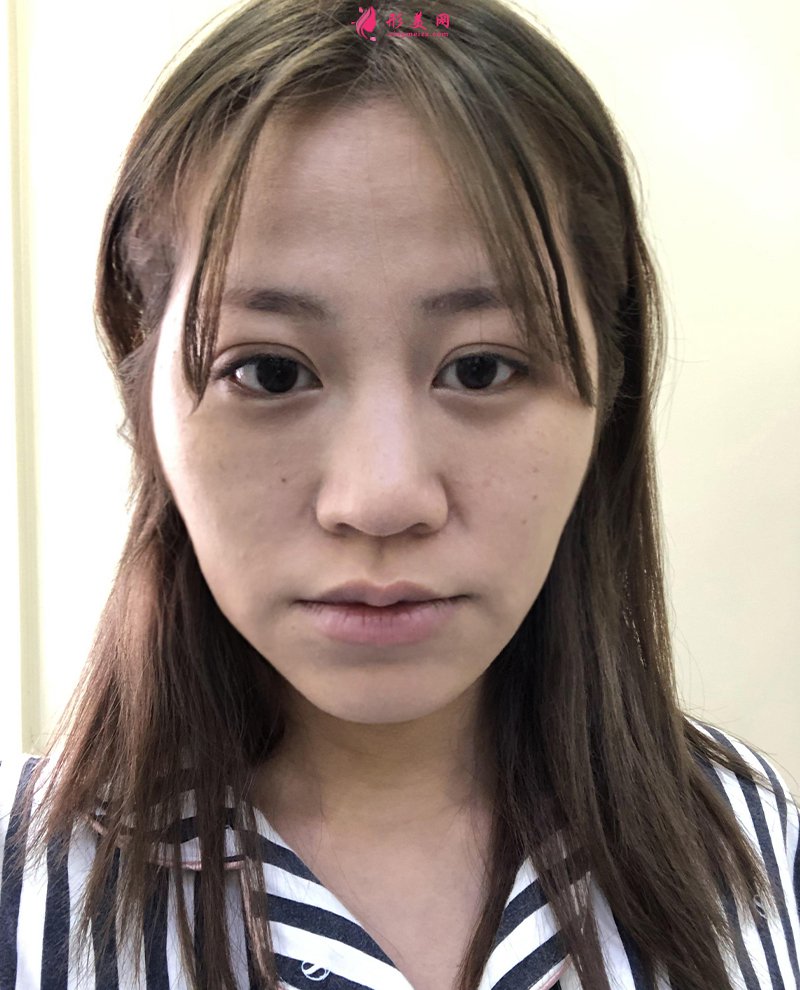 上海自體脂肪面部填充前后對比圖