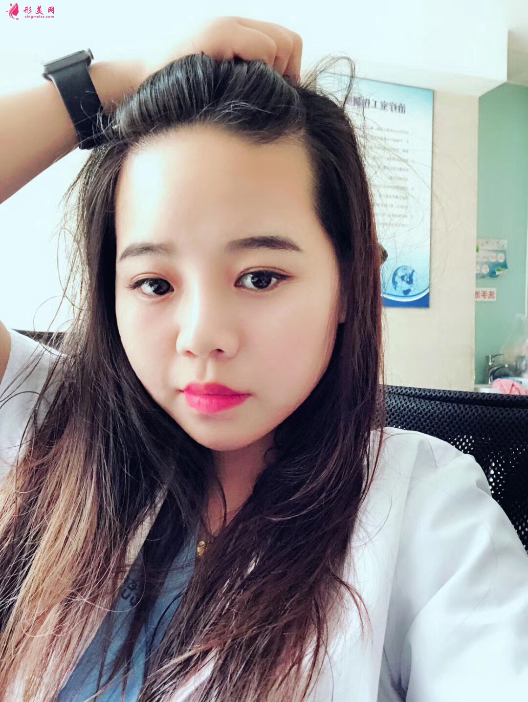 植發(fā)后還會(huì)脫發(fā)嗎？