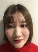 南京華美美容醫(yī)院隆鼻怎么樣？，200天效果分享