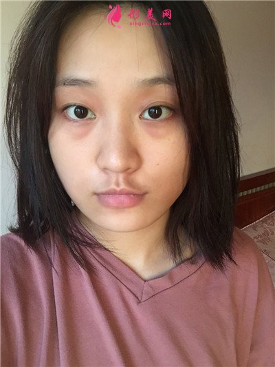 杭州面部埋線提升術(shù)后恢復(fù)情況對比