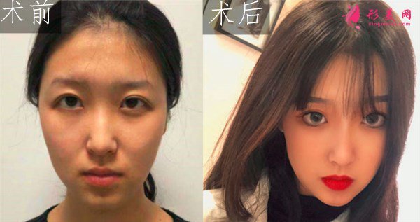 寧波靜港整形自體脂肪面部填充案例