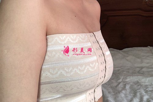 廣州假體隆胸效果分享 術后 廣州假體隆胸效果分享