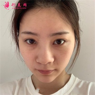 深圳假體隆鼻術(shù)后恢復(fù)情況反饋