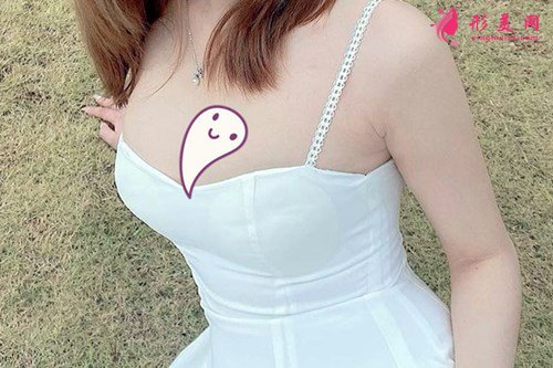 北京假體隆胸的效果分享