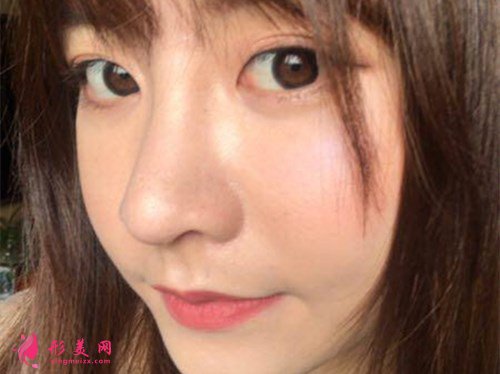 成都肋軟骨隆鼻案例效果分享 術(shù)后 成都肋軟骨隆鼻案例效果分享