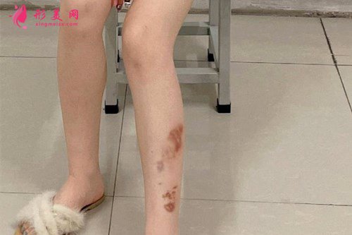 廣州激光祛疤手術(shù)效果分享