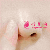 縮鼻翼手術(shù)后遺癥明顯嗎