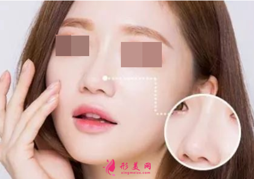 縮鼻翼手術(shù)多少錢