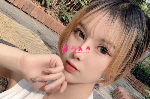 上海顴弓降低手術(shù)分享 術(shù)后 上海顴弓降低手術(shù)分享