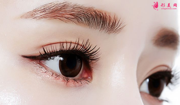 上瞼下垂矯正術(shù)要多少錢