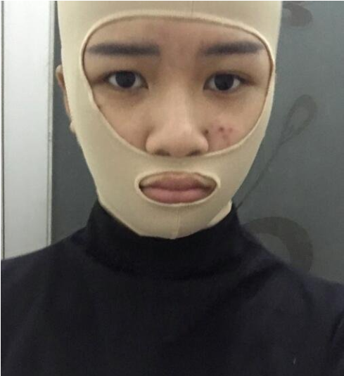 上海九院顴骨內(nèi)推多少錢？全新價格表來襲！附案例分享